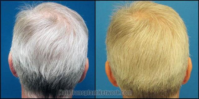 Before and after surgical hair restoration images