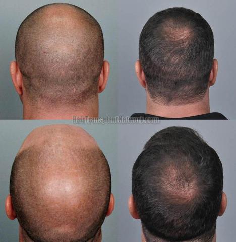 Hair restoration procedure before and after pictures