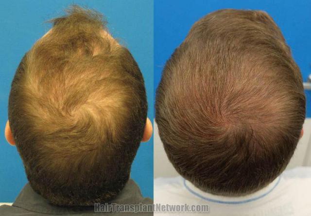 Back view before and after hair transplantation photos