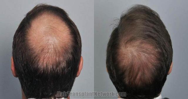 Hair transplantation surgery before and after images