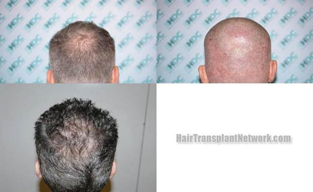 Hair transplantation surgery before and after pictures