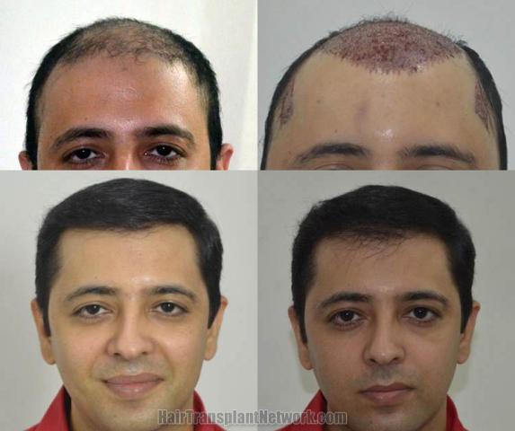 Hair restoration procedure before and after results