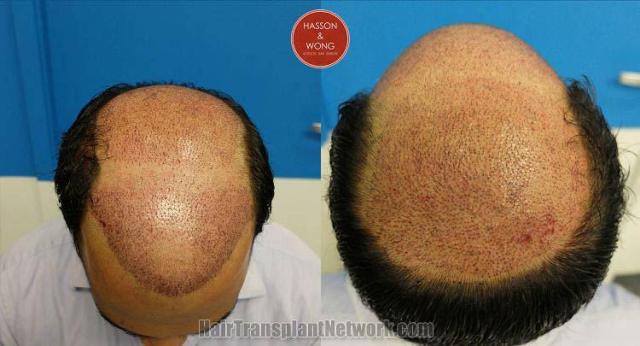 Hair restoration surgery before and after photos