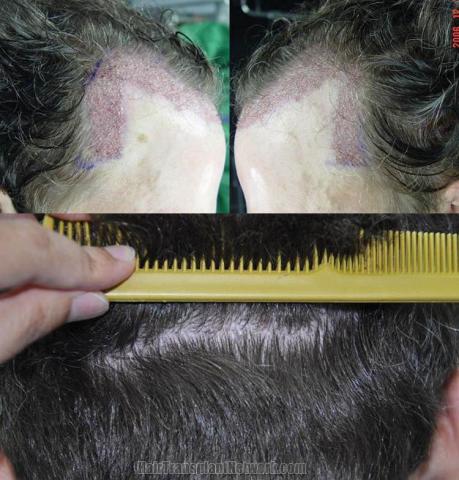 Hair transplantation surgery before and after pictures