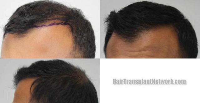 Hair transplantation surgery before and after pictures