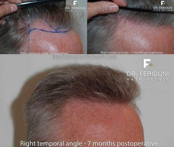 Top views displaying Follicular Unit Extraction hair restoration