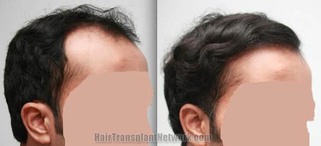 Hair transplantation surgery before and after images