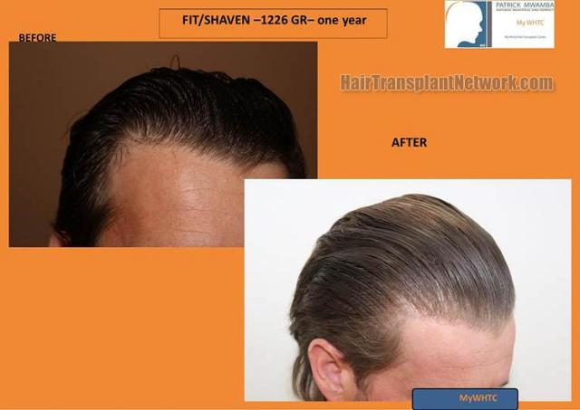 Hair transplantation surgery before and after images