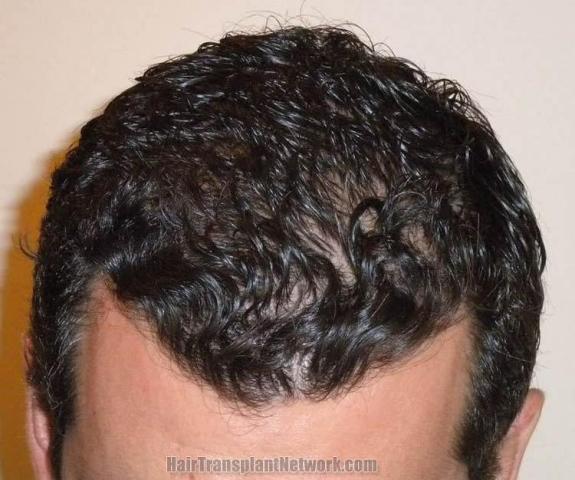 Hair restoration surgery before and after photos