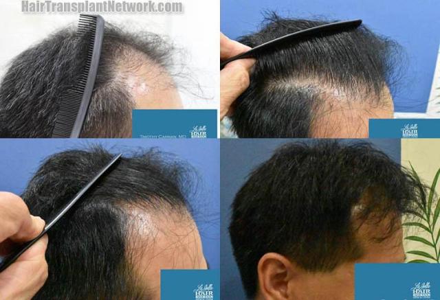 Hair restoration procedure before and after results