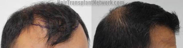 Hair transplantation surgery before and after images