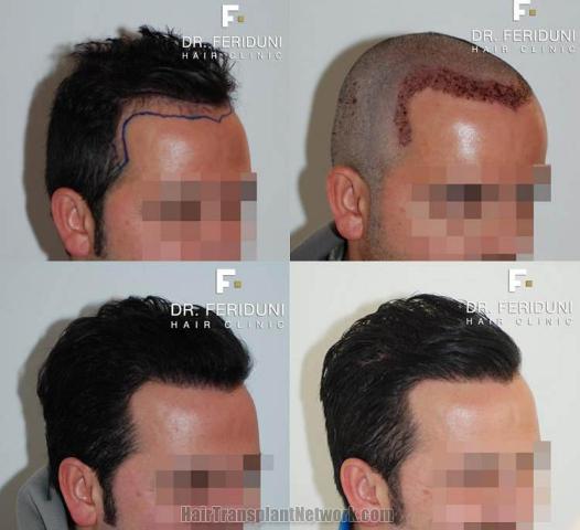 Hair restoration procedure before and after pictures