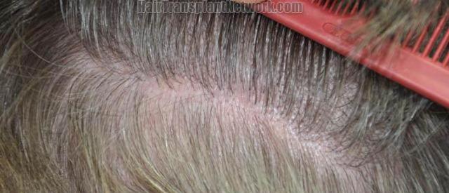 Hair restoration surgery before and after photos