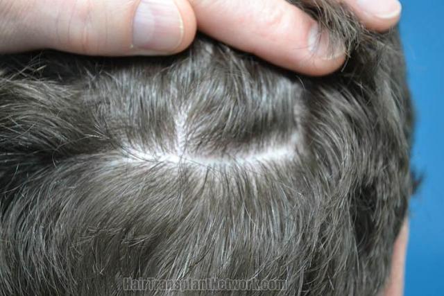 Hair transplant surgery before and after photos