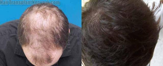 Hair transplantation surgery before and after images