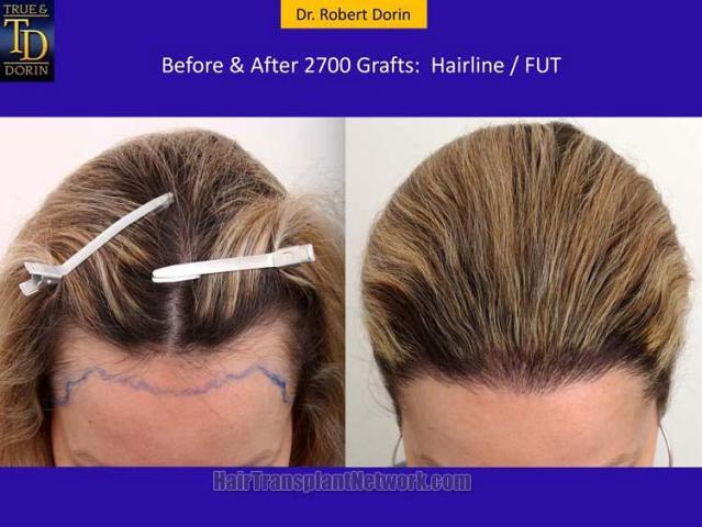 Hair transplantation surgery before and after images