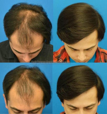 Top view - Before and after surgical hair replacement