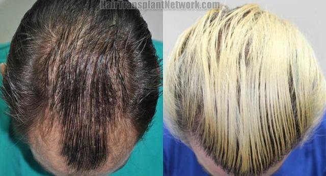 Hair restoration procedure before and after pictures