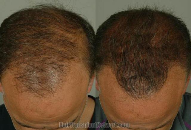 Top view - Before and after surgical hair replacement