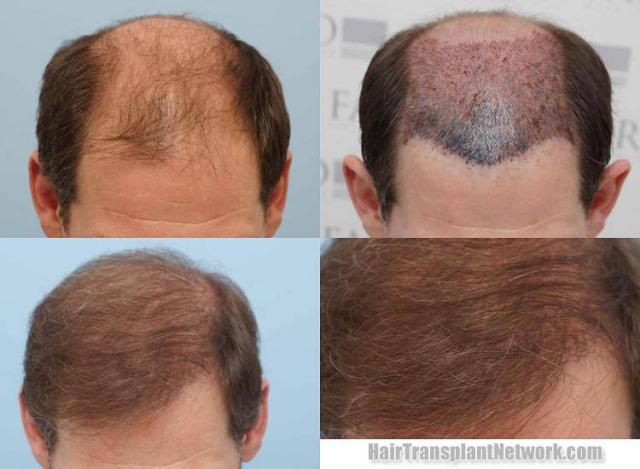 Top view before and after hair restoration results