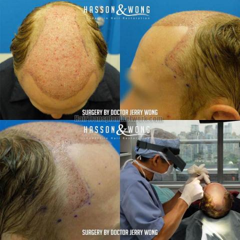 Hair restoration procedure before and after result images