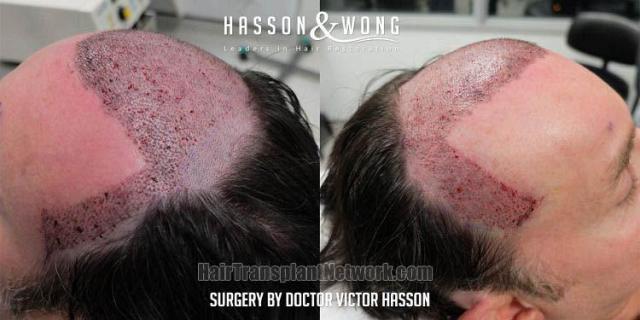 Hair replacement surgery before and after images