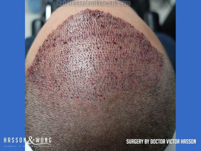 Surgical hair transplantation result photographs