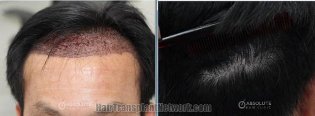 Surgical hair transplantation result photographs