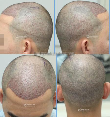 Hair replacement surgery before and after images