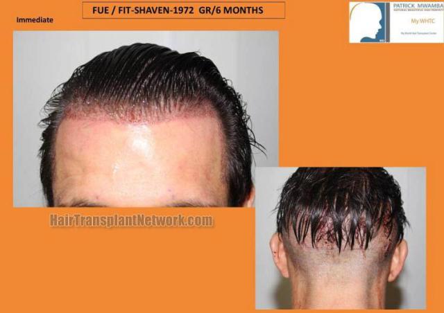 Hair restoration surgery before and after photos