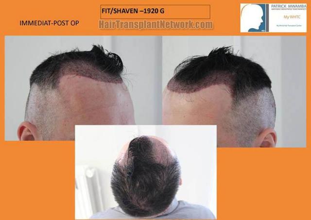 Hair restoration procedure before and after pictures