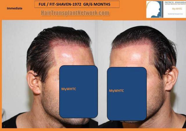 Hair transplant surgery before and after pictures