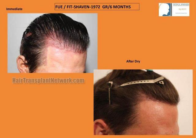 Hair transplantation surgery before and after photos