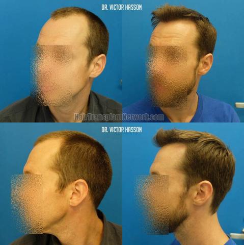 Before and after hair transplant procedure images