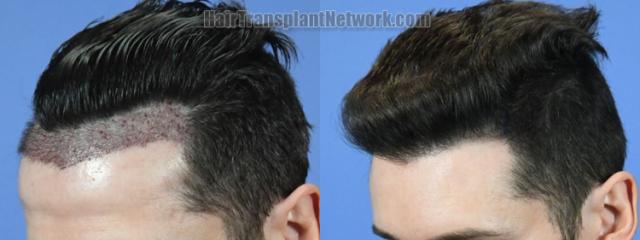 Before and after hair transplantation result photographs