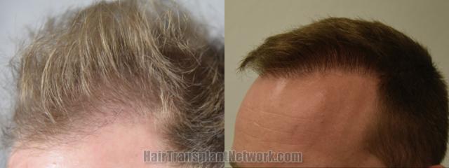 Before and after hair transplantation result photographs