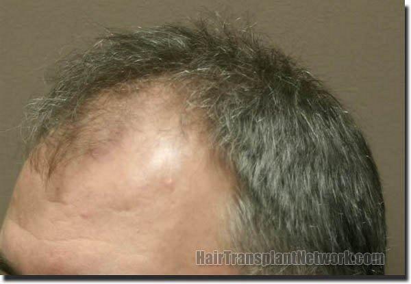 Hair restoration procedure results