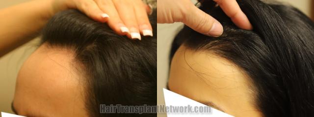 Before and after hair transplantation result photographs