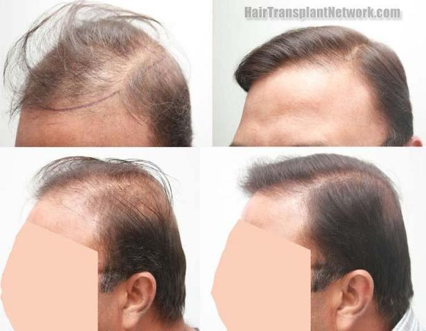 Hair transplantation surgery before and after photos