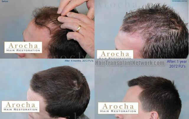 Hair transplantation surgery before and after pictures