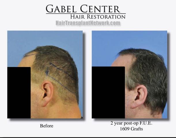 Hair transplantation surgery before and after images