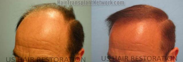 air transplantation surgery before and after images