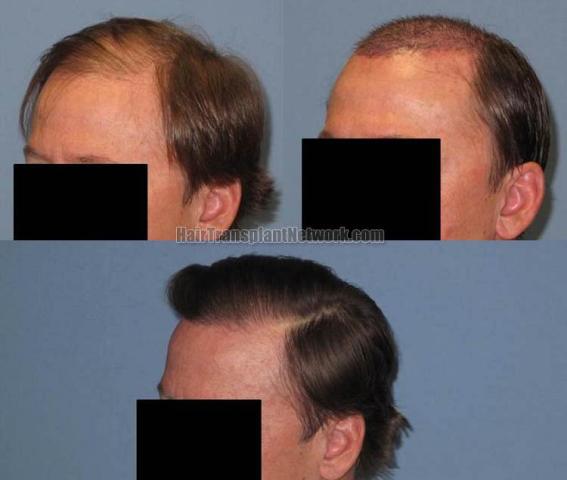 Hair transplantation surgery before and after pictures