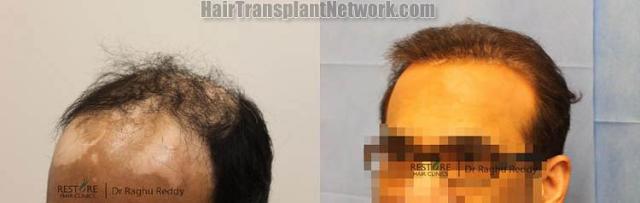 Hair transplantation surgery before and after images