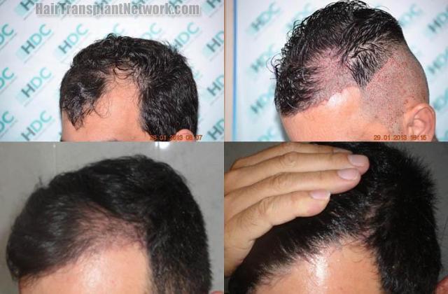 Hair transplantation surgery before and after pictures