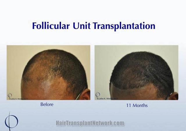 Hair transplantation surgery before and after images