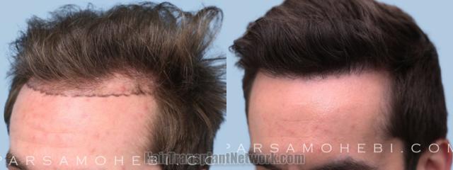 Before and after hair transplantation result photographs