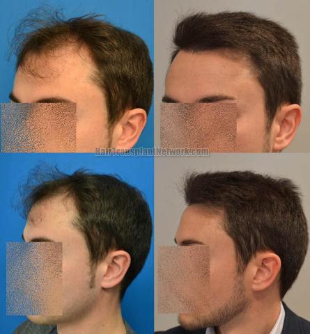 Hair transplantation surgery before and after images