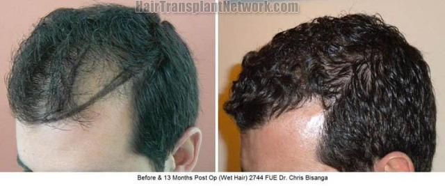 Hair transplantation surgery before and after pictures