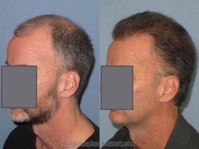 Hair transplantation surgery before and after pictures